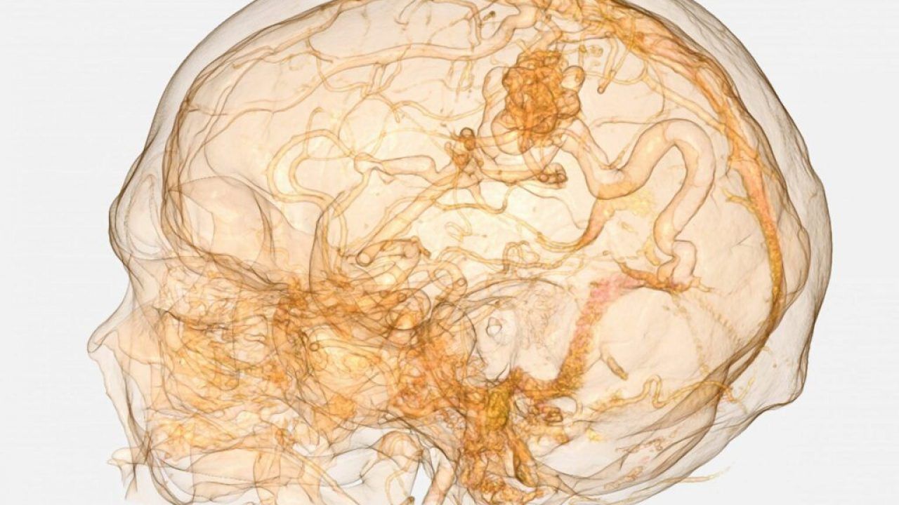 Arteriovenous Malformation (AVM)