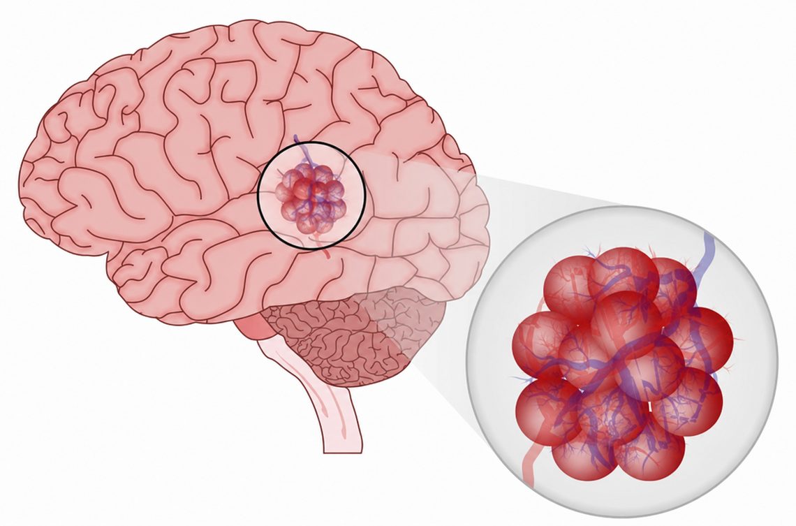 Cavernous Malformation (Cavernoma)
